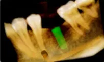 implant x-ray dentist